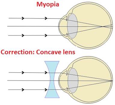 Where is the image in eye formed for a person suffering from defect of ...