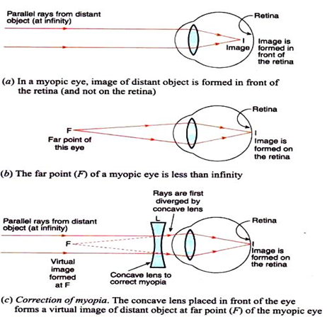 Name the defect of vision which can be corrected by a diverging lens ...